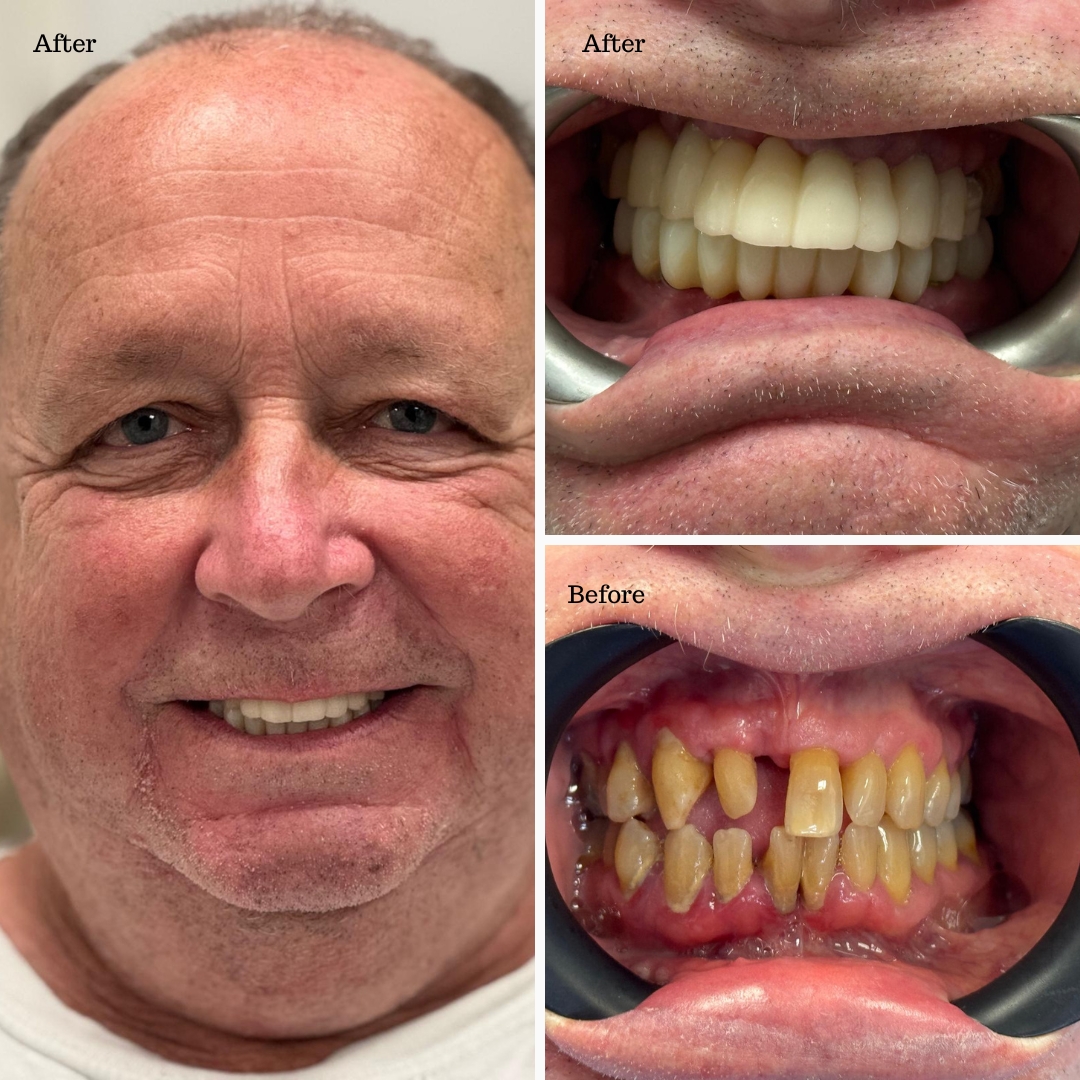 Dental implant before and after result at Ardent Smile Clinic