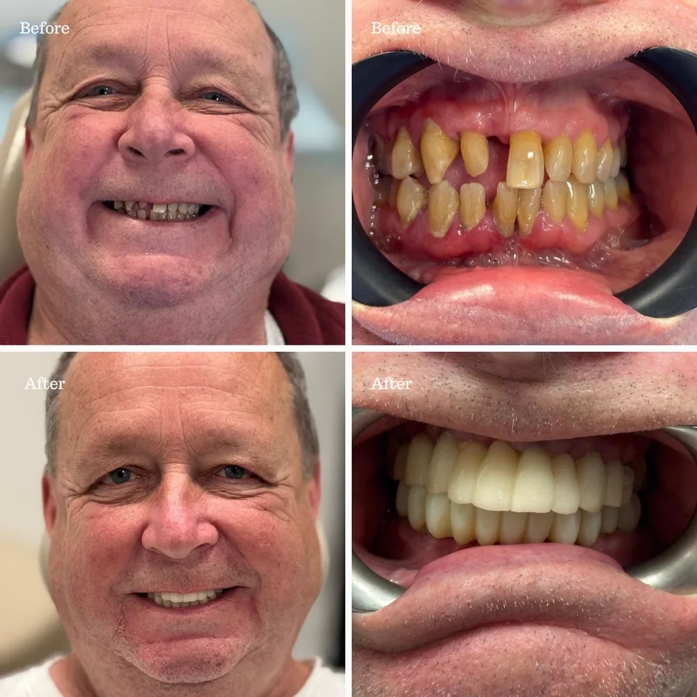 Before and after dental treatment transformation for an older female patient