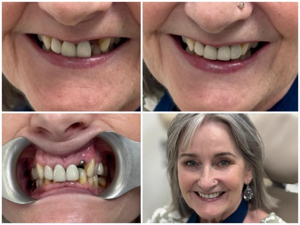 Before and after dental implant smile transformation for an older male patient
