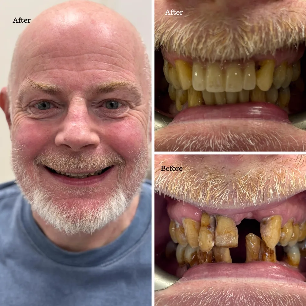 Before and after smile transformation for a middle-aged female patient