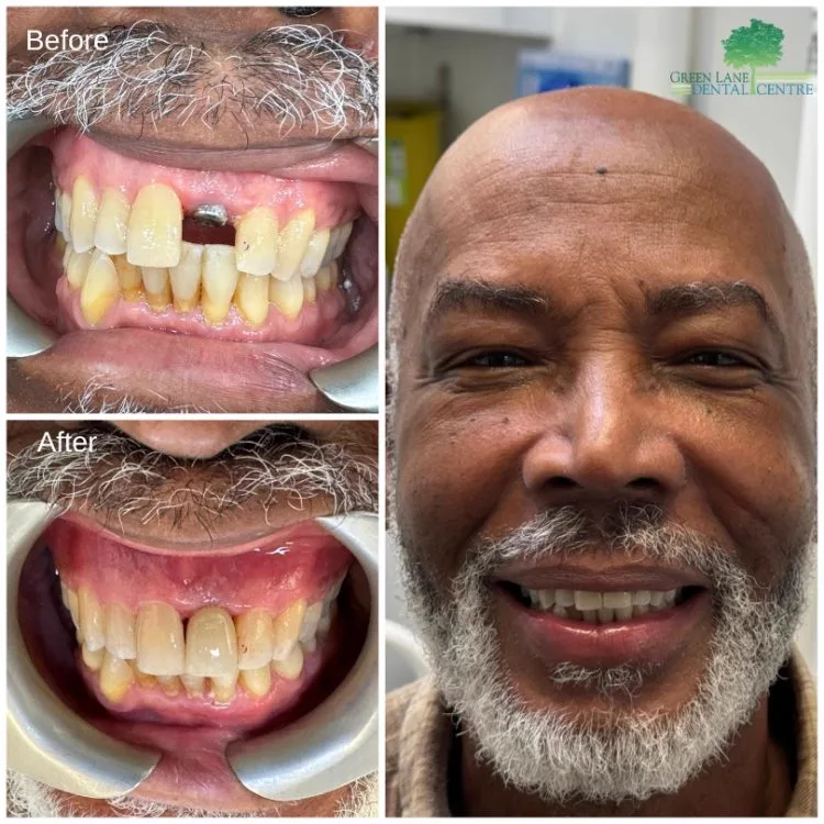Before and after full smile makeover for a male patient