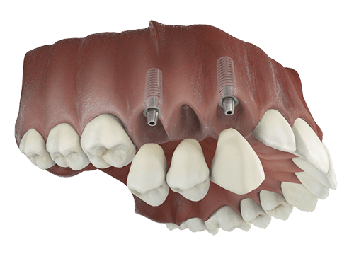 Implant-supported bridge replacing multiple missing teeth