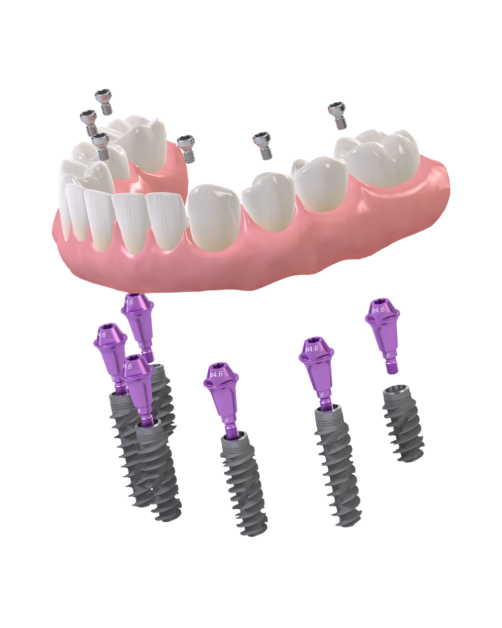 All-on-4 dental implant system with angled abutments