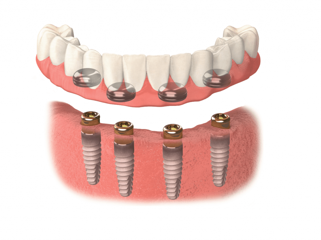 Locator-retained implant denture on four implants