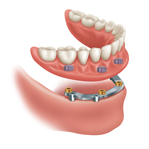 Bar-retained implant denture attached to a metal bar on implants
