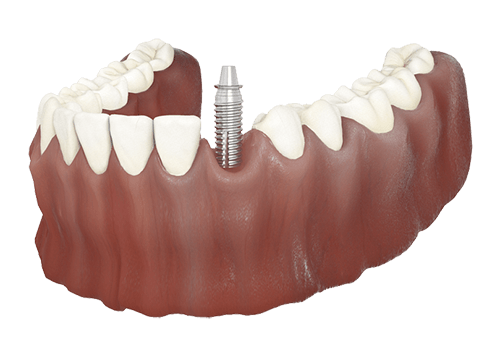 Single dental implant with crown between natural teeth
