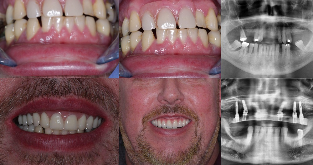 Before and after full upper arch implants with fixed bridge at Ardent Smile Clinic