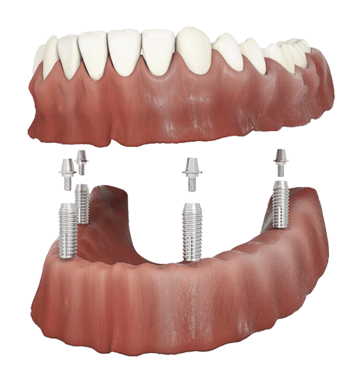 Denture secured onto dental implants in the jaw