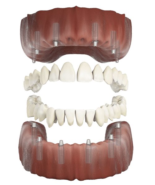 All-on-6 full arch dental implant bridge