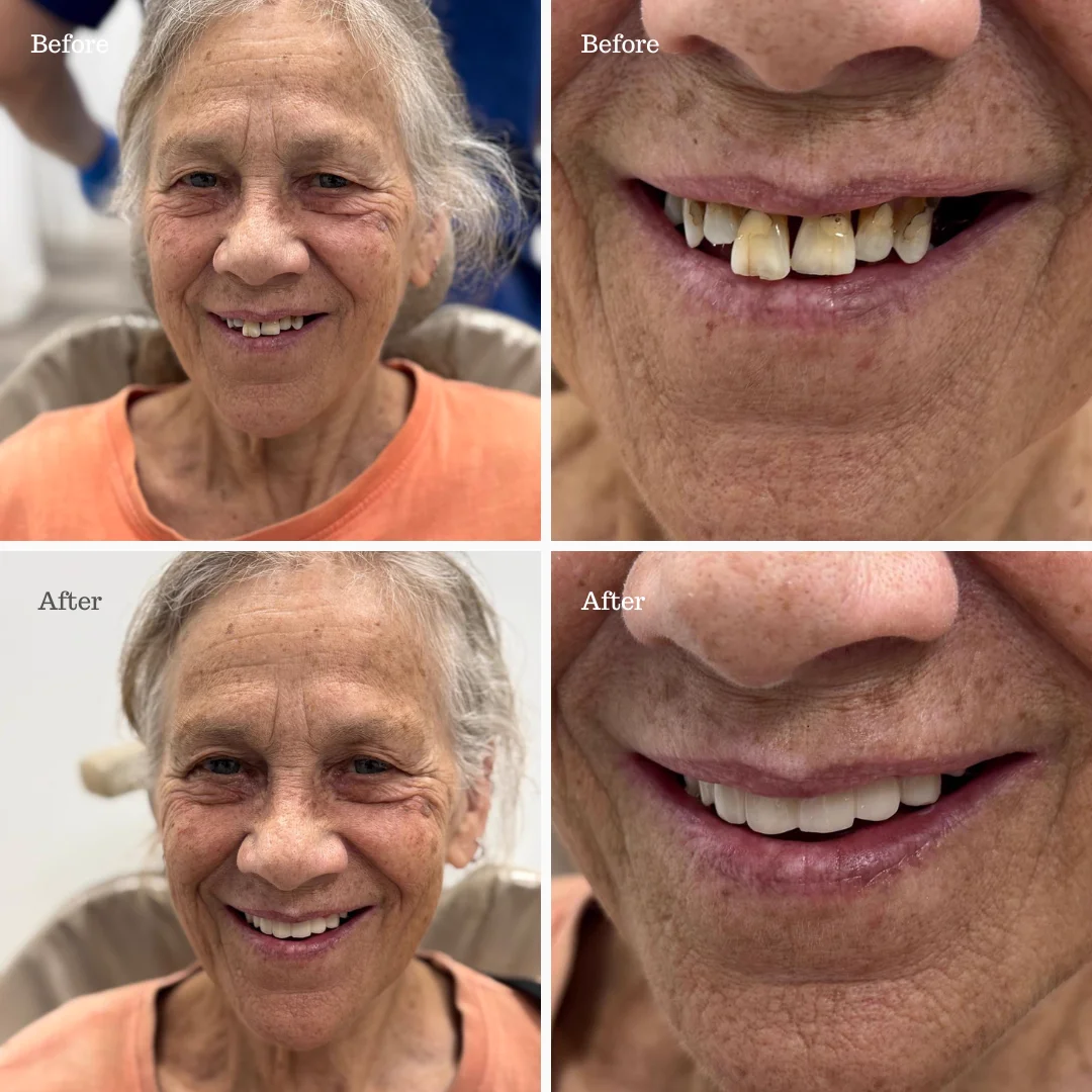 Before and after dental implant smile transformation for an older female patient