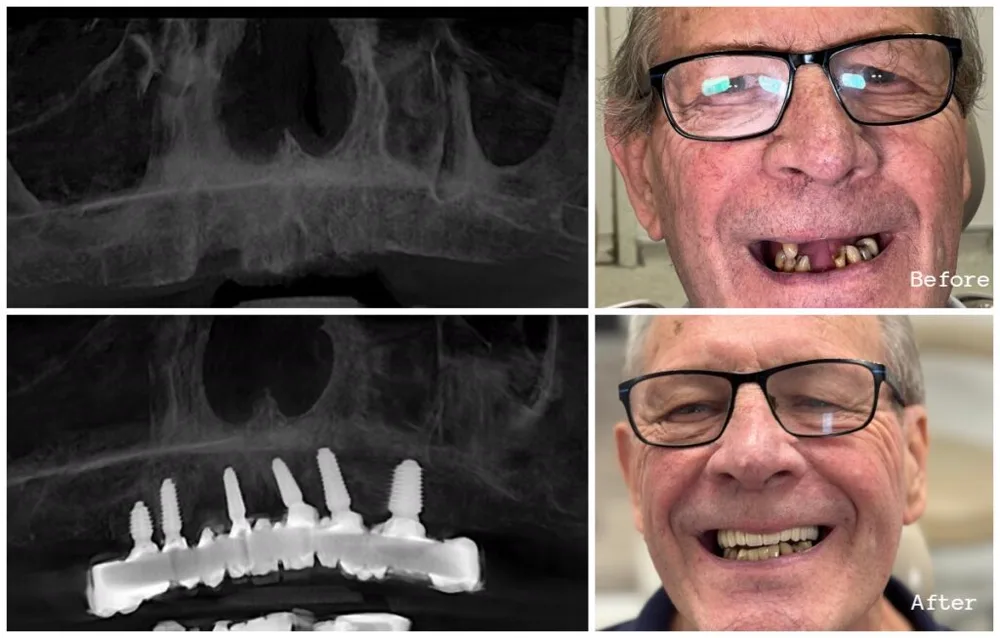 Before and after cosmetic dental transformation for a female patient