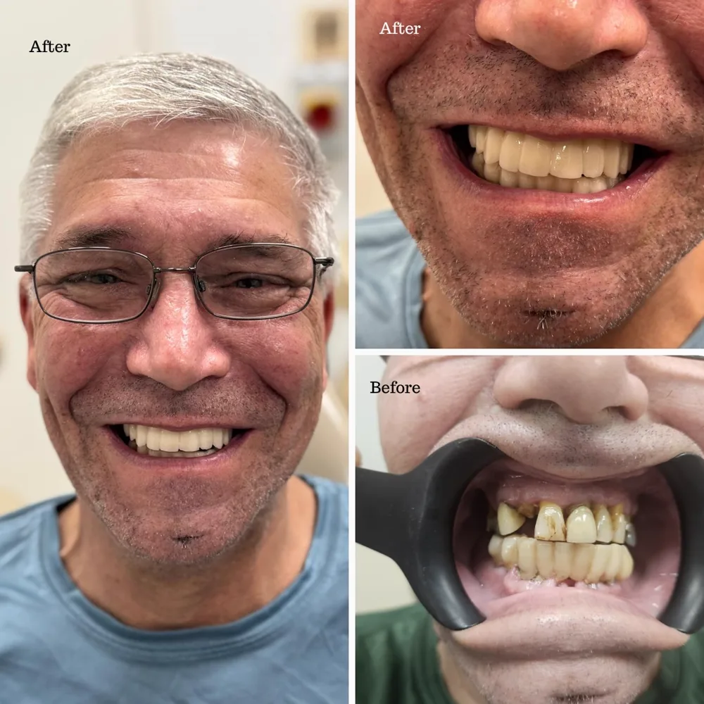 Before and after dental implant smile restoration for a female patient