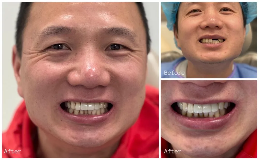Before and after smile restoration for an older male patient