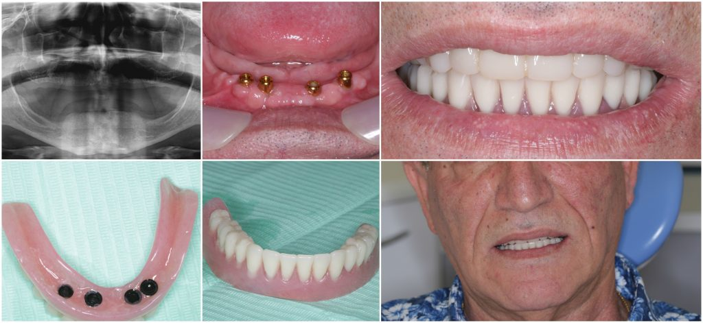 Before and after implant-supported lower denture case at Ardent Smile Clinic